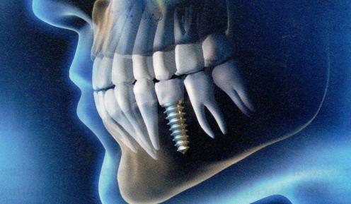 Implant